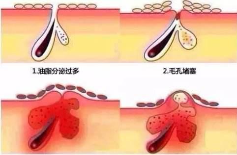 闭口粉刺和痘痘的区别