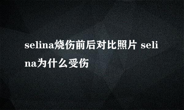 selina烧伤前后对比照片 selina为什么受伤