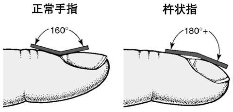 杵状指的形成原因