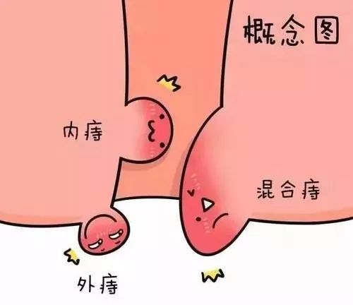 痔疮外痔肉球怎么消除？