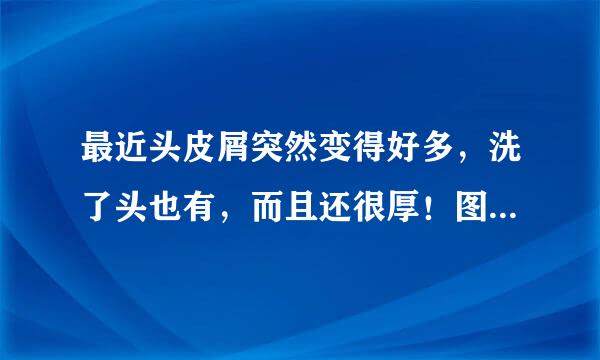 最近头皮屑突然变得好多，洗了头也有，而且还很厚！图片是从头皮上扣下来的头皮屑