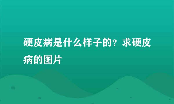 硬皮病是什么样子的？求硬皮病的图片