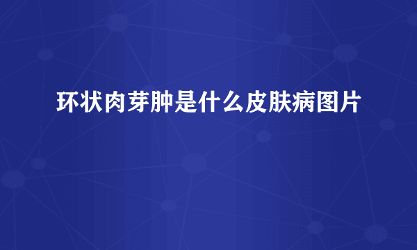 环状肉芽肿是什么皮肤病图片