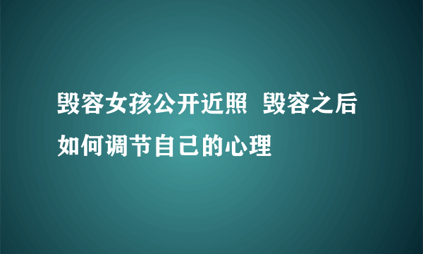 毁容女孩公开近照  毁容之后如何调节自己的心理